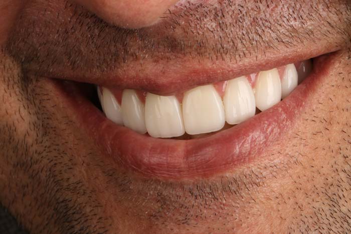 The image shows a close-up of a person with a broad smile, displaying white teeth and a mustache.