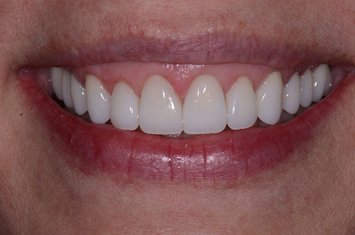 The image shows a person smiling with white teeth, displaying a bright smile against a neutral background.