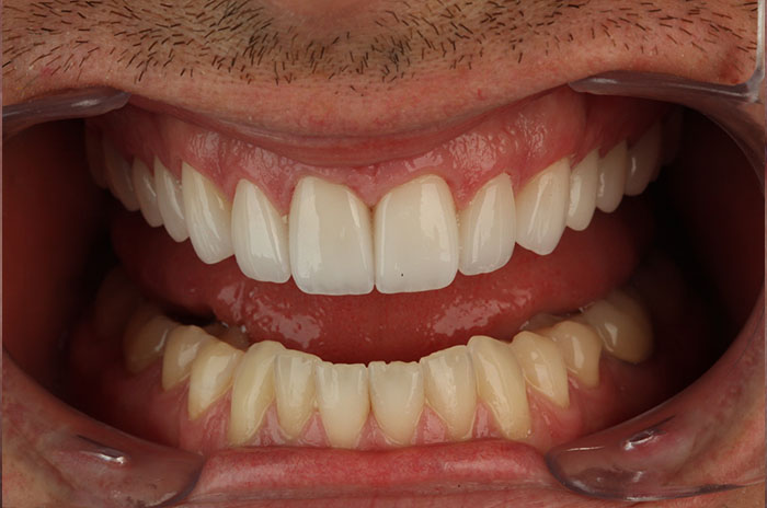 The image displays a close-up view of a person s teeth, showcasing a bright smile with white teeth and pink gums, set against a blurred background that suggests a dental office environment.
