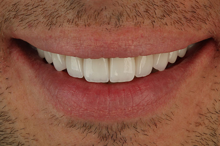 The image shows a close-up of a person s smiling face with white teeth, wearing lipstick, and has a goatee.