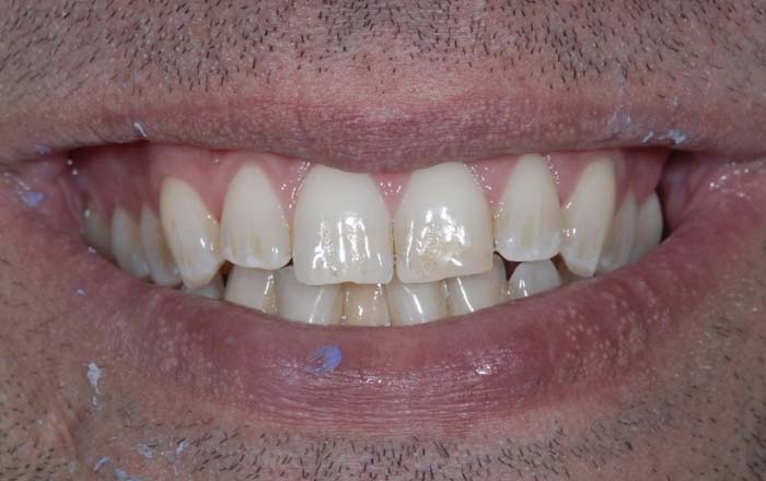 The image shows a close-up view of an individual s smiling mouth with visible dental work, including teeth whitening and possibly orthodontic treatment, against a blurred background that does not provide any additional context.