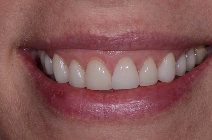 The image shows a close-up of a person s smiling face with straight white teeth, wearing lipstick, and appears to be middle-aged or older.