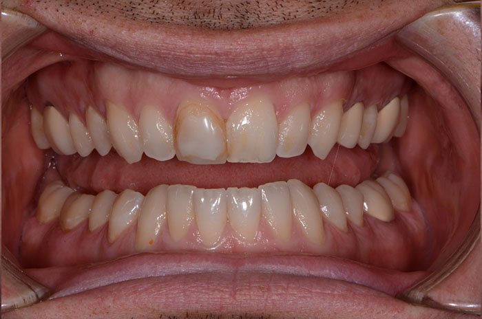 The image displays a close-up view of a person s teeth and lips, showcasing a wide smile with well-maintained dental hygiene.