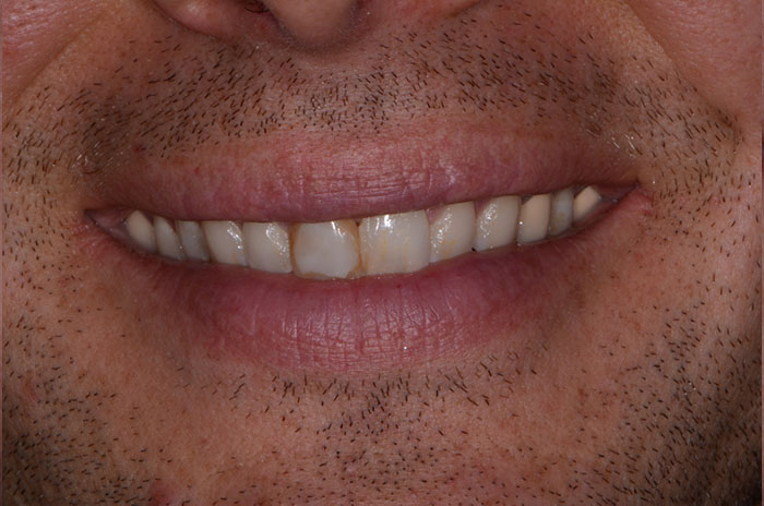 The image shows a close-up of a person s face with a wide smile revealing teeth and gums, and the individual has a beard and mustache.